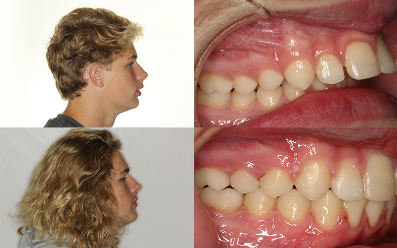 overbite before and after