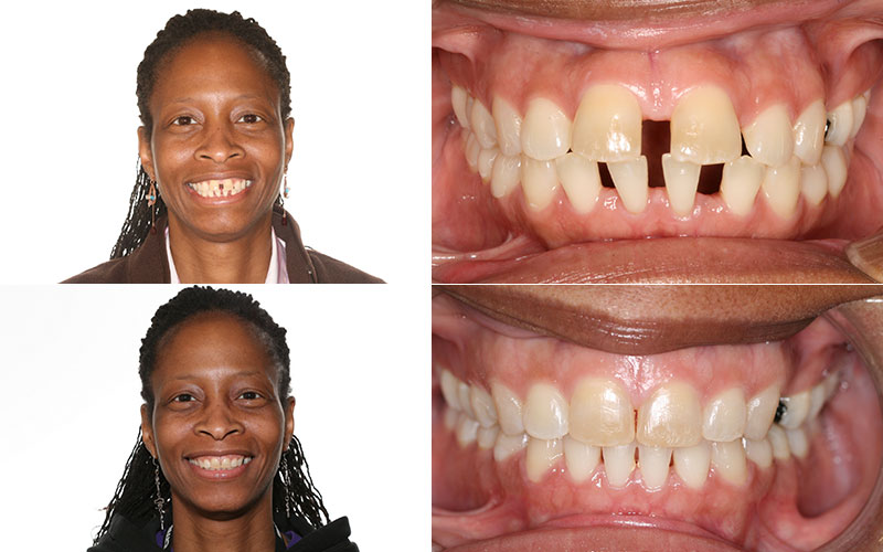 before and after braces adults