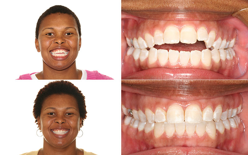 Elastic Wear Protocol-Northlake-University-Charlotte Orthodontist