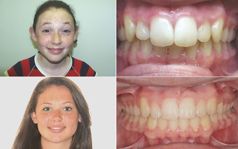 Before And After Orthocare Orthodontics Charlotte Nc Spartanburg Sc