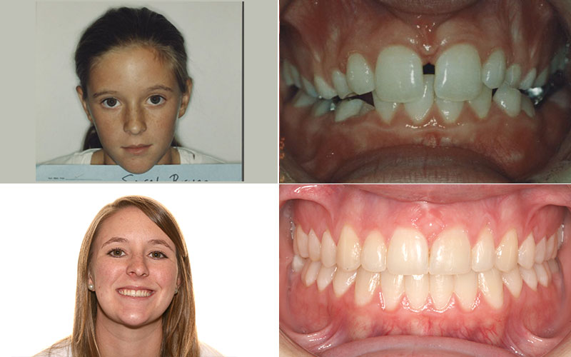 Before And After Orthocare Orthodontics Charlotte Nc Spartanburg Sc