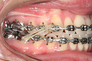 Elastics and Braces