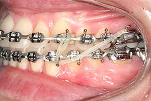 Vertical elastics 2025