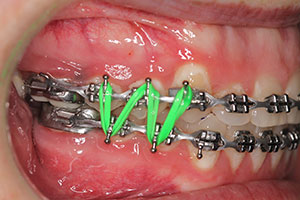 Orthodontic Elastics FAQs, WNY Orthodontists