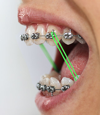 How Long to Wear Rubber Bands for Braces