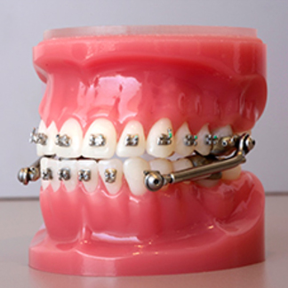 Herbst Appliance Orthodontist Charlotte NC OrthoCare Orthodontics