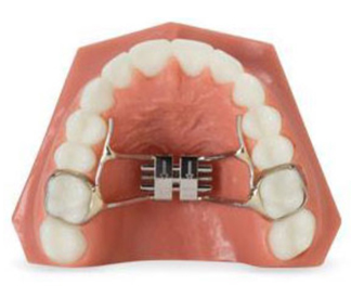 palatal expander